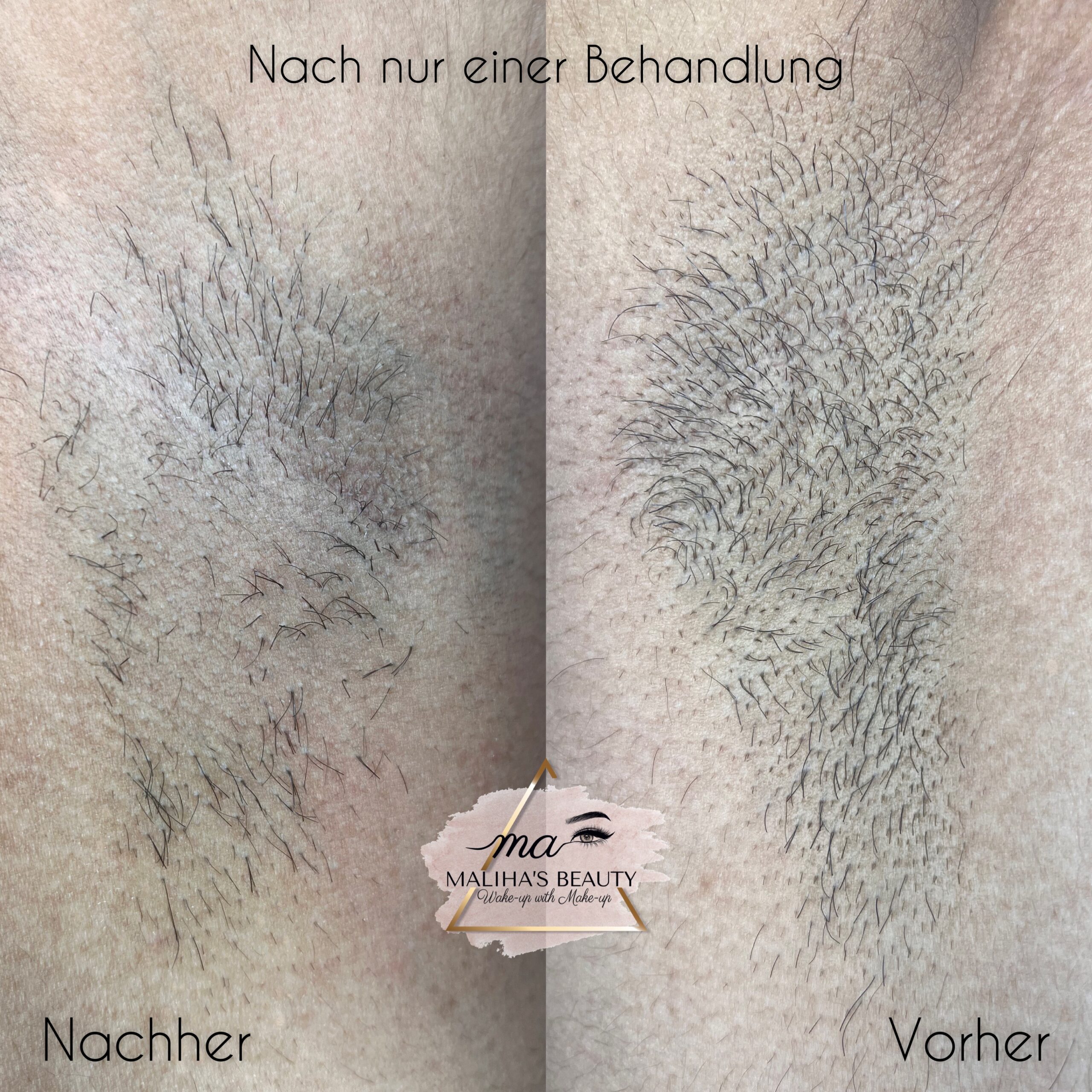 Dauerhafte Haarentfernung 5